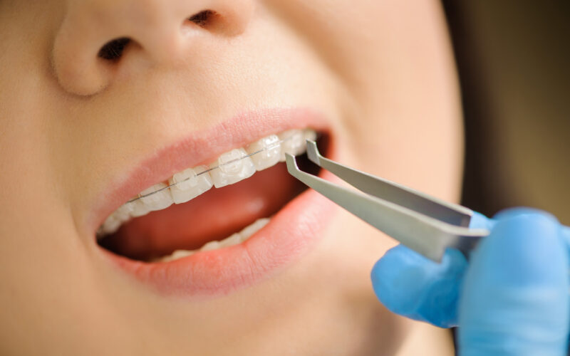 ceramic braces treatment in Hadapsar