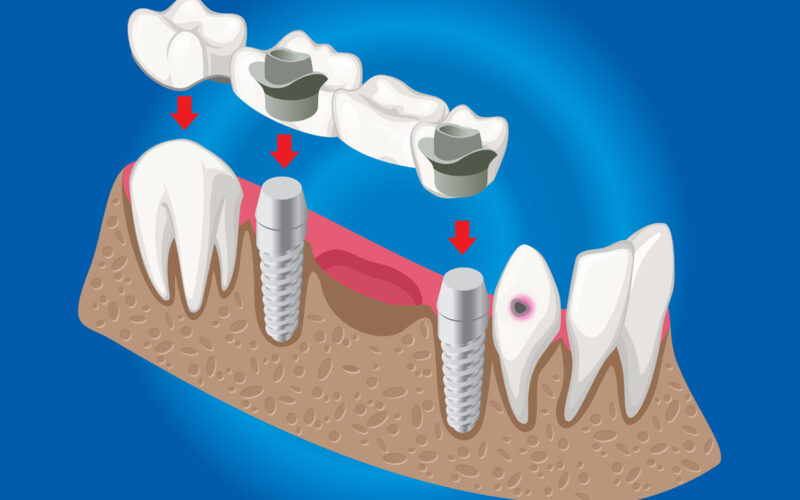 dental crown replacement in Hadapsar