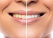 Teeth whitening in Hadapsar