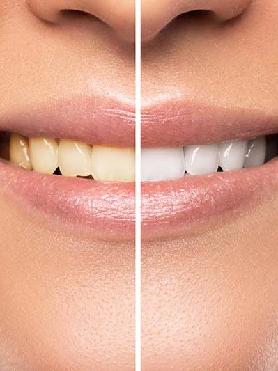 Teeth whitening in Hadapsar