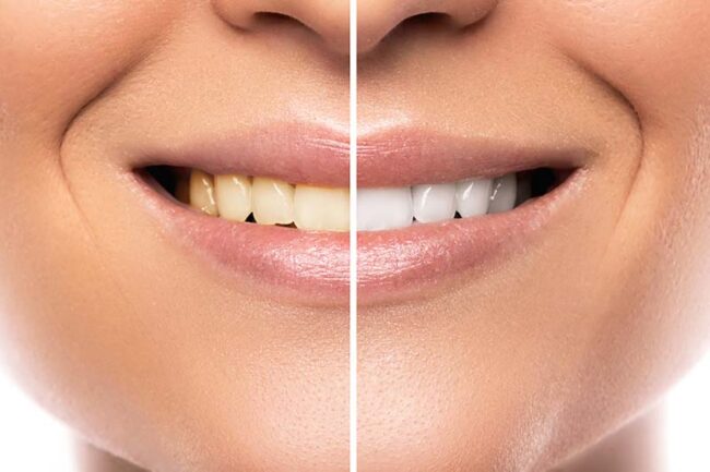 Secrets to Whiten the Teeth Teeth whitening in Hadapsar